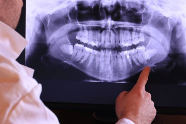 Best Emergency Treatment for Dental Infections or Abscesses in Cloverdale, VA